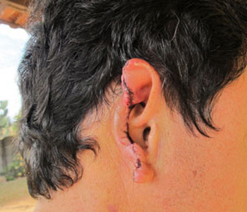 O pai perdeu parte da orelha durante a agresso.