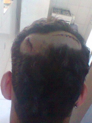 Vítima recebeu dez pontos na cabeça, após agressão.