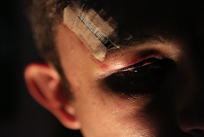 Marcas da agresso sofrida por P.R.; ele teve um osso da face fraturado no ltimo domingo.