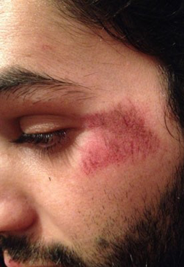 Danilo Pimentel diz ter sido vtima de homofobia: leso perto do olho foi decorrente de agresso.