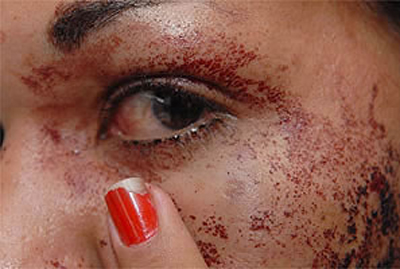 A v�tima teve o rosto perfurado pela chave do carro do agressor.