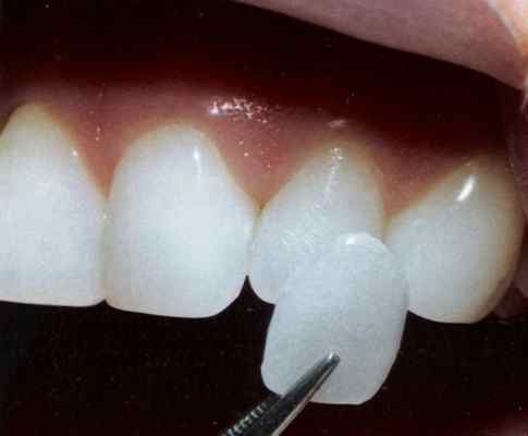 O uso da lente dental � est�tico, na maior parte das vezes.