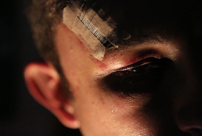 Marcas da agress�o sofrida por P.R.; ele teve um osso da face fraturado no �ltimo domingo.