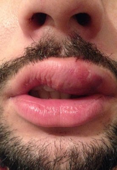 Danilo Pimentel mostra l�bio inchado ap�s ter sido agredido